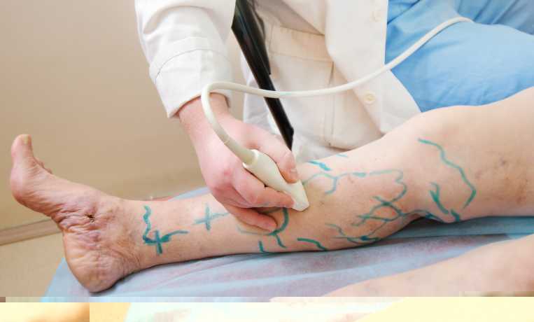 Лазерная операция по удалению варикоза