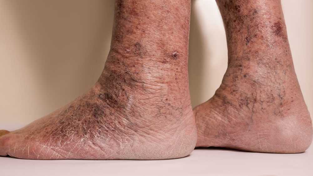 Варикозный дерматит