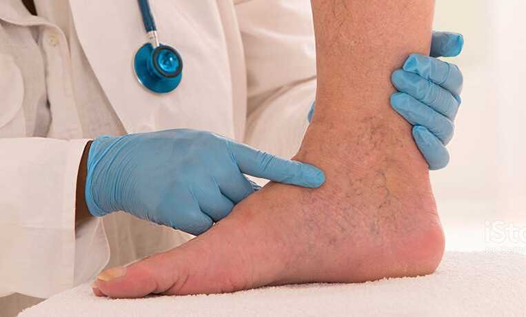 Варикоз стопы признаки развития патологии