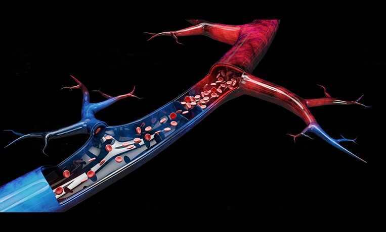 Трофические язвы при варикозе: что это и как избавиться