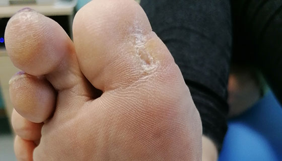 Признаки и симптомы диабетической стопы