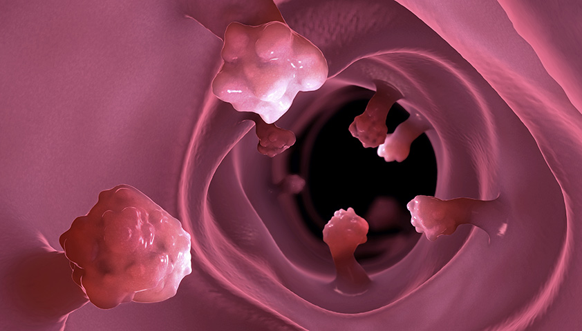 Полипы. Почему их важно выявить как можно раньше
