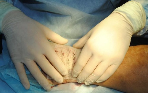 Риски и осложнения при оперативном лечении трофических язв