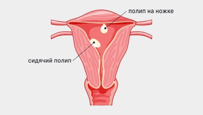 Полипы эндометрия (ПЭ)