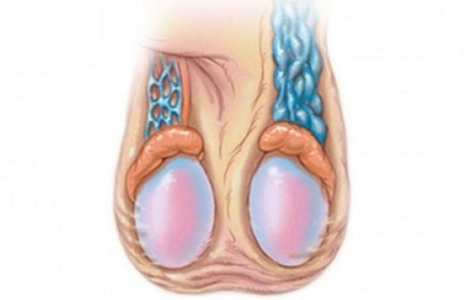 ЧТО БУДЕТ, ЕСЛИ НЕ оперировать варикоцеле?