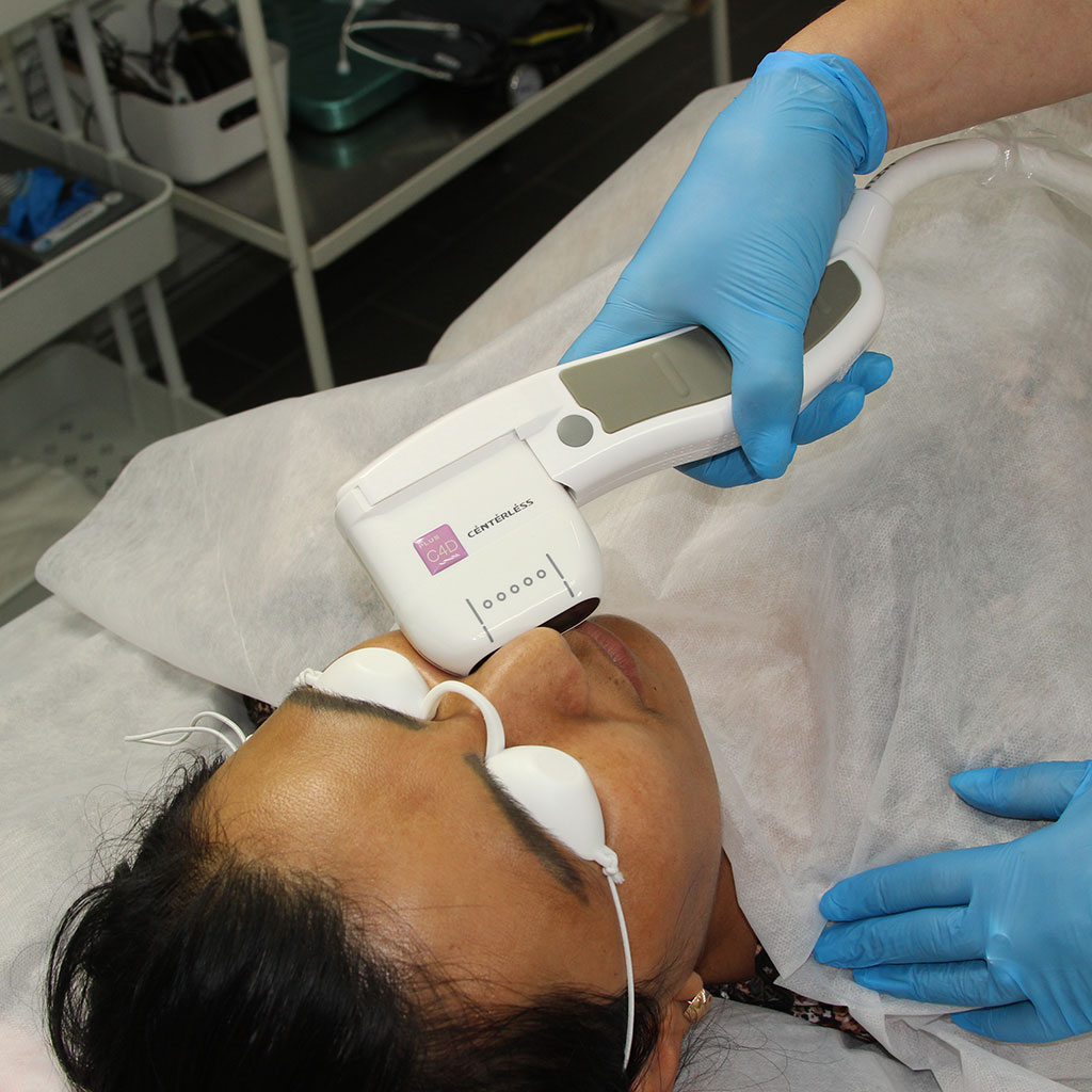 SMAS-лифтинг лица