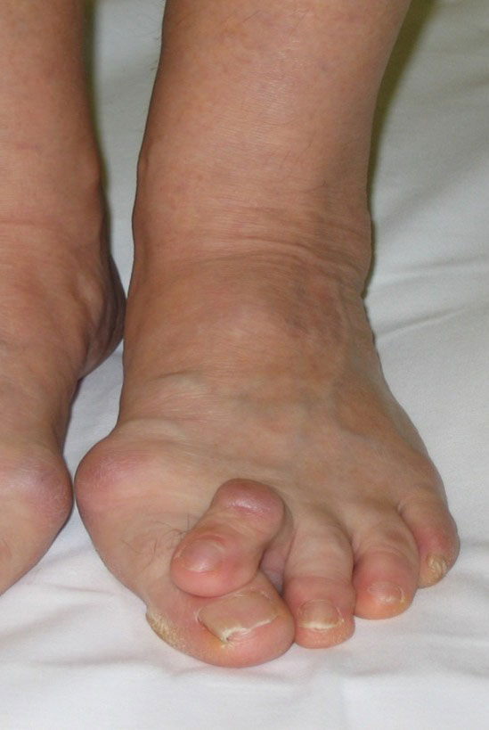 Лечение вальгусной деформации стопы (hallux valgus)