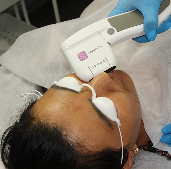 SMAS-лифтинг: Безоперационная подтяжка лица со скидкой 15%!