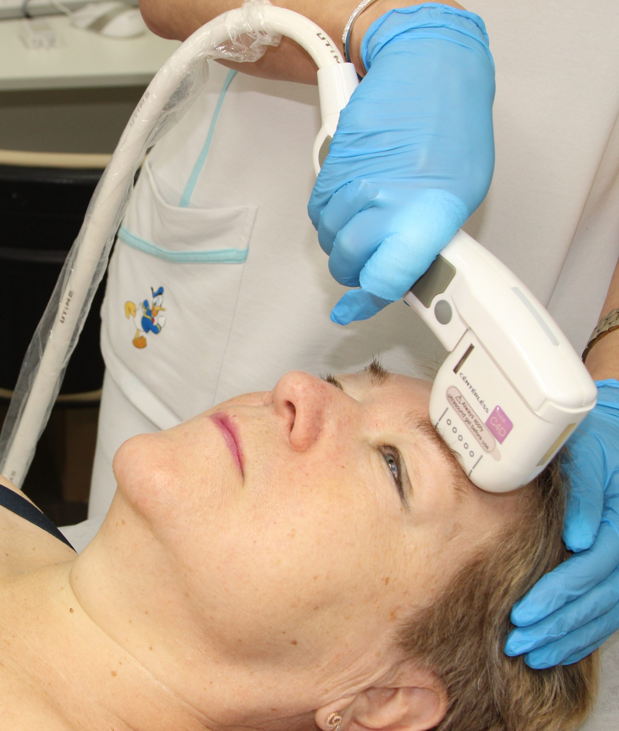 SMAS-лифтинг лба