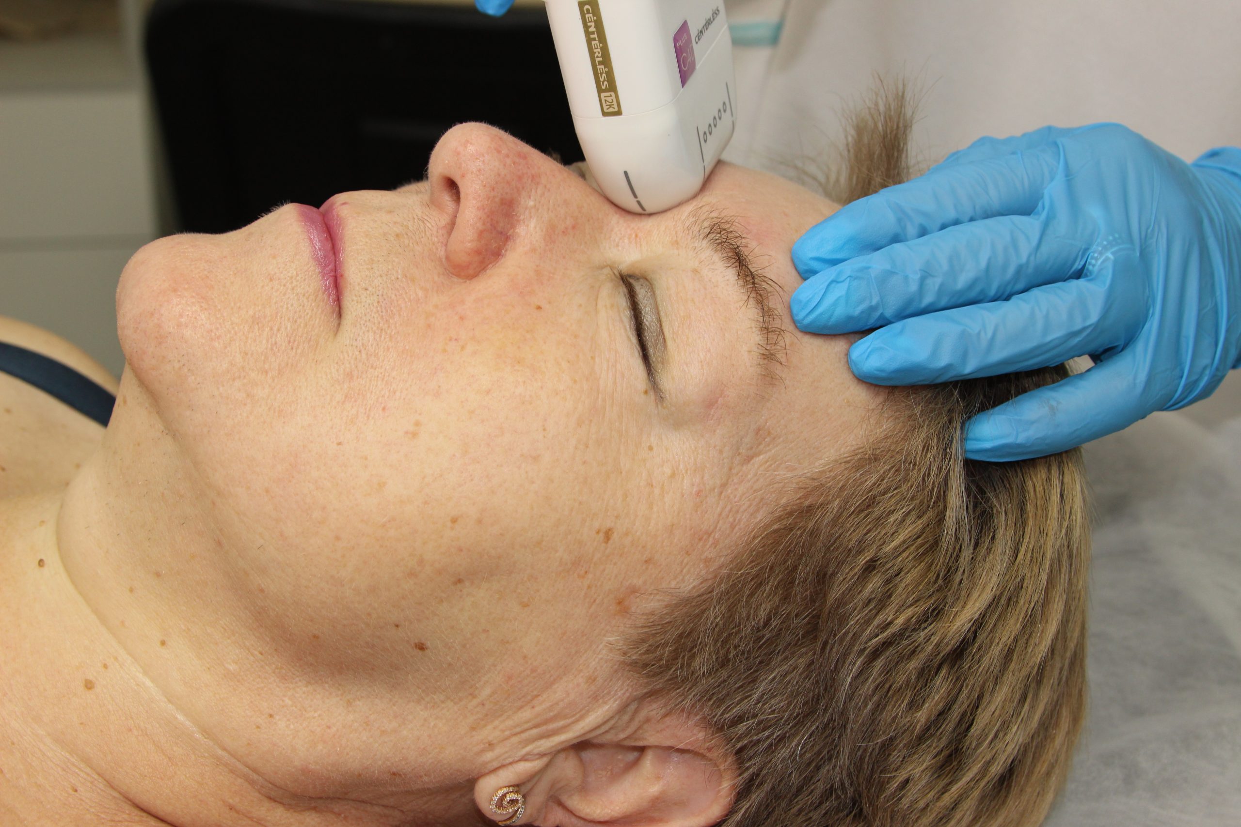 SMAS-лифтинг в клинике Доктора Бегмы