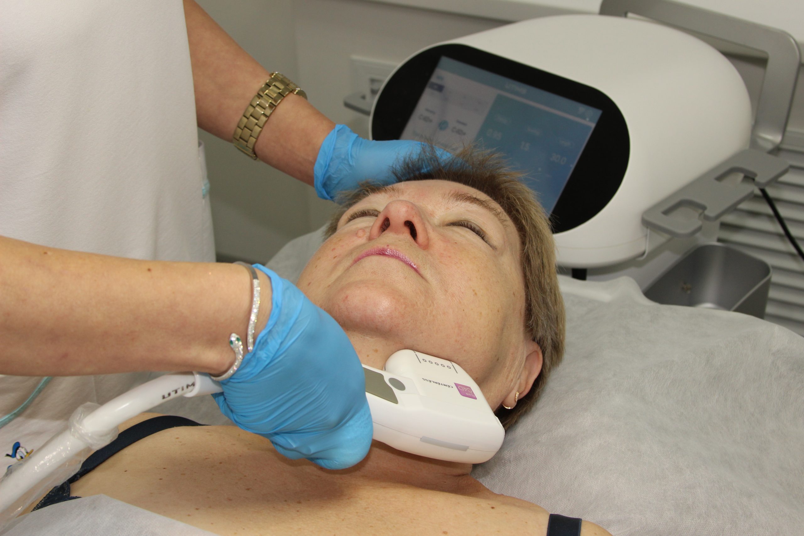 Эффект от SMAS-лифтинга