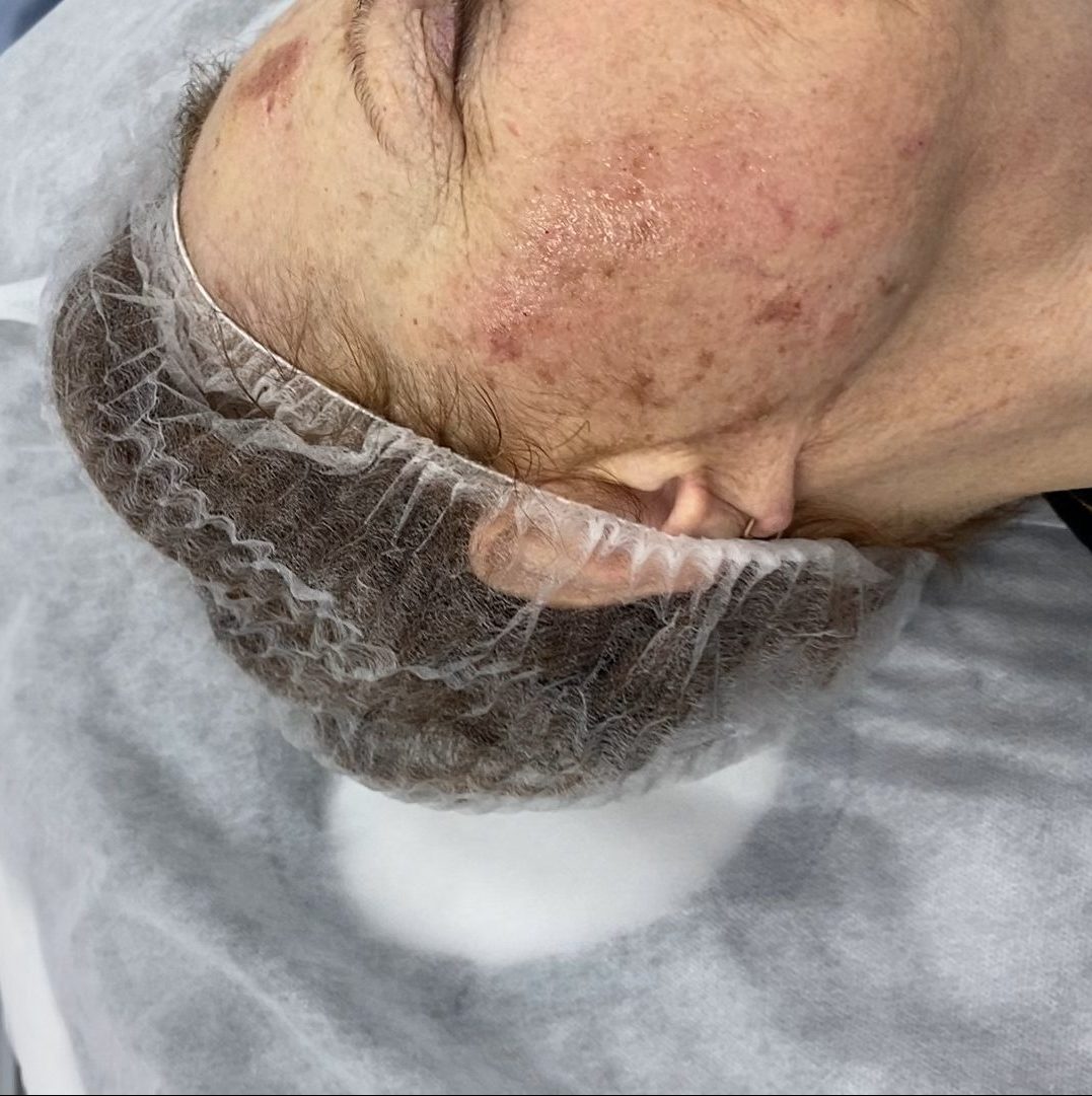 Удаление пигментных пятен лазером Удаление пигментных пятен лазером