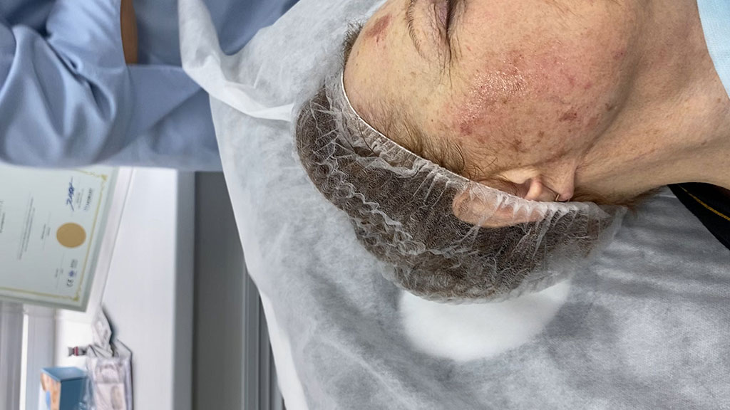 Преимущества элос-фототерапии для лица