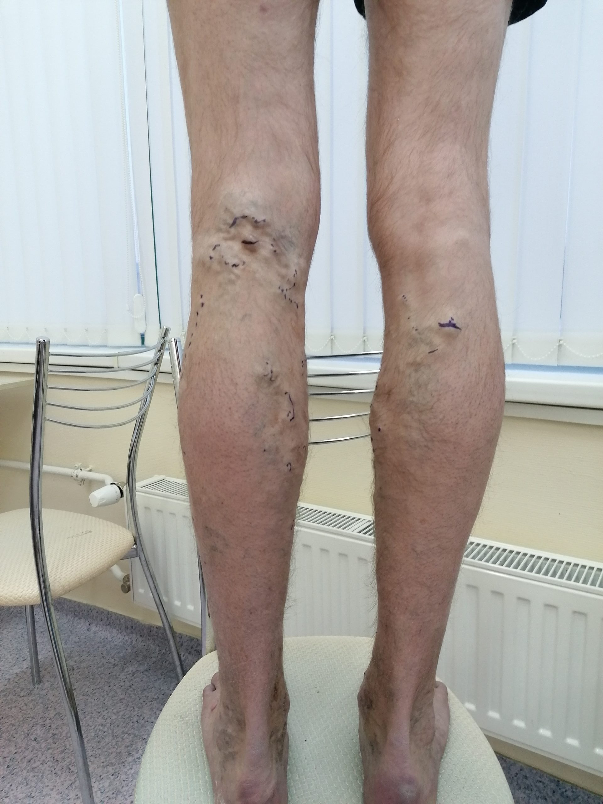 Преимущества комбинированной флебэктомии вен