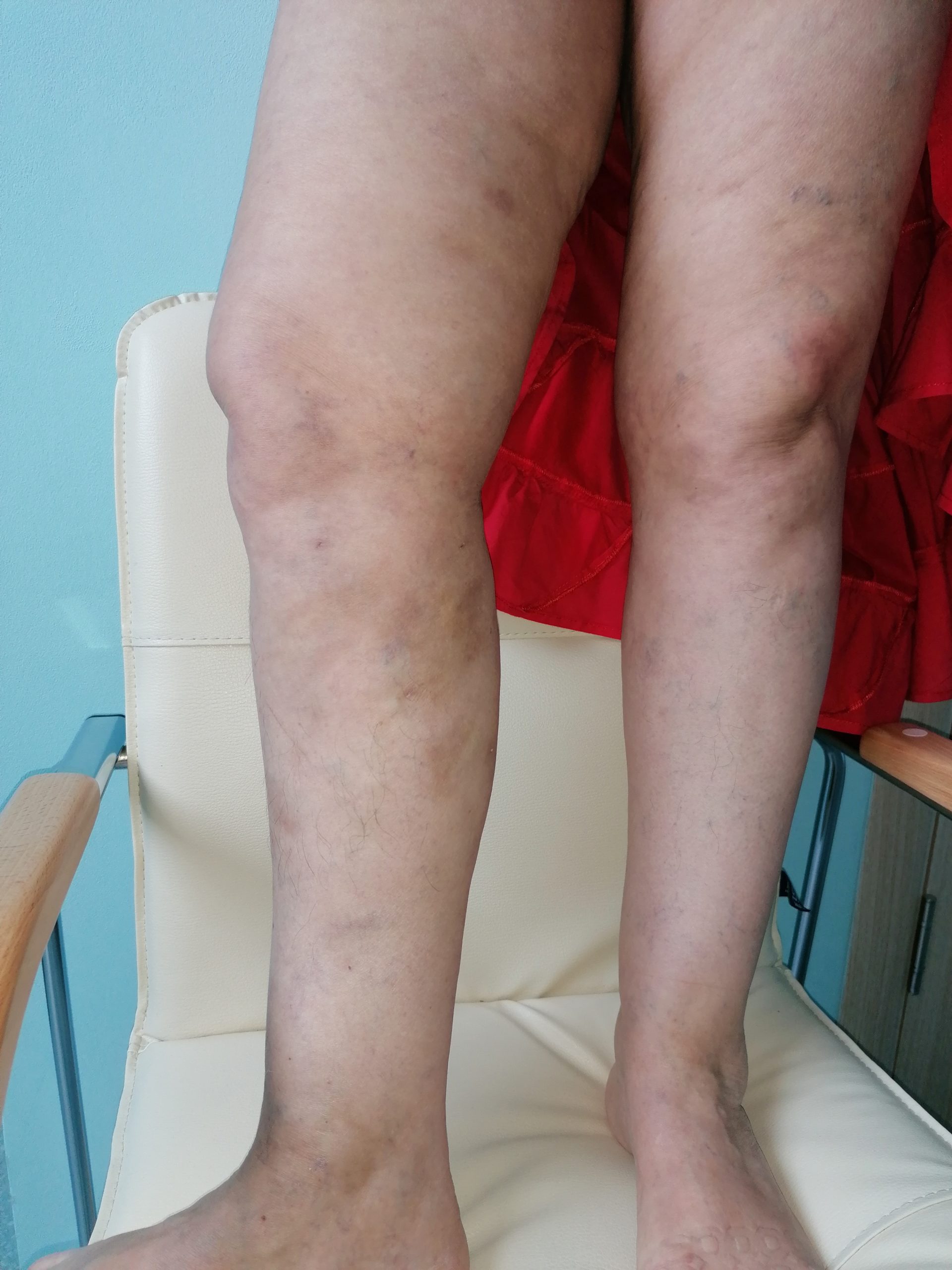 Минифлебэктомия Минифлебэктомия