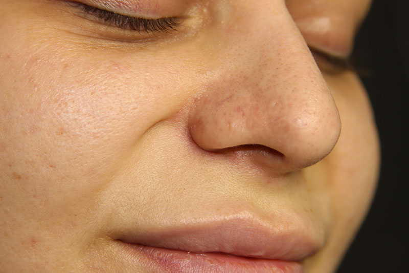 Преимущества удаления купероза на лице лазером