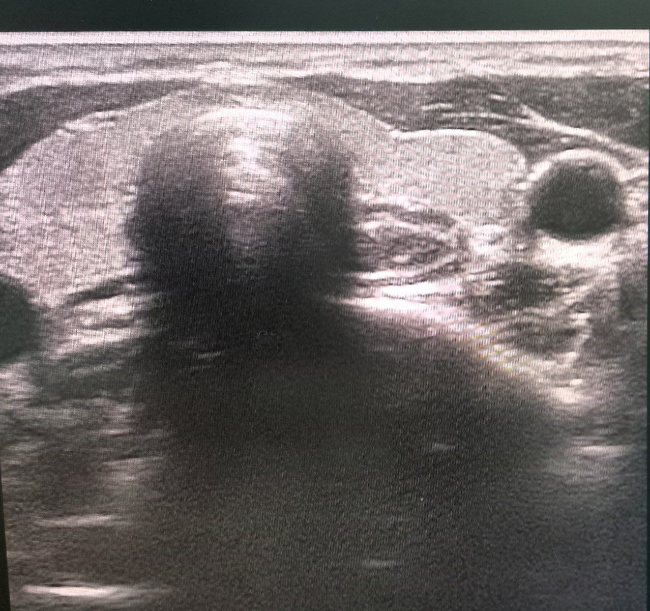 Показания к склеротерапии узлов щитовидной железы