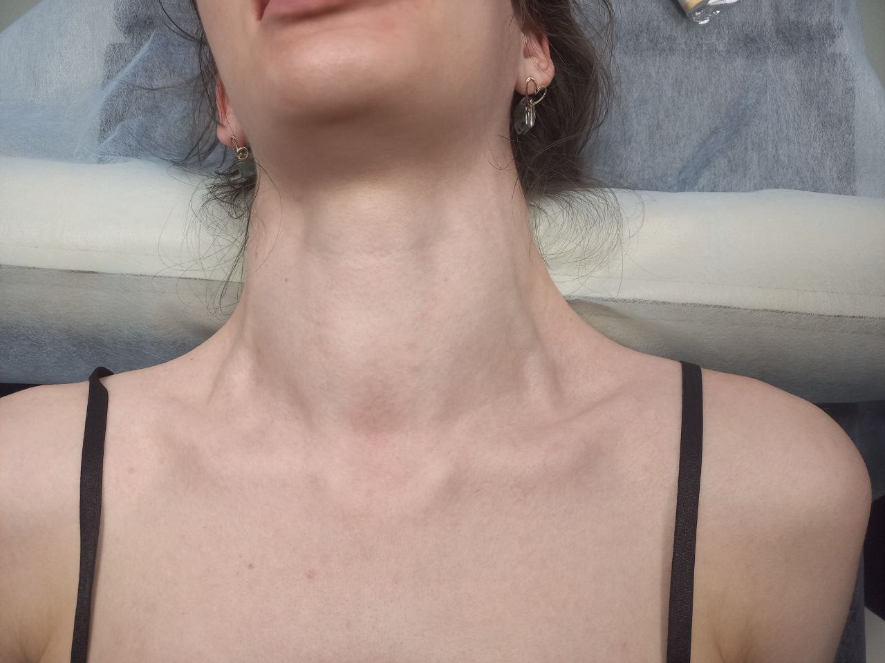 Склеротерапия узлов щитовидной железы