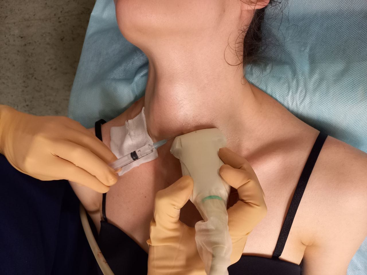 Как проводится склеротерапия узлов щитовидной железы