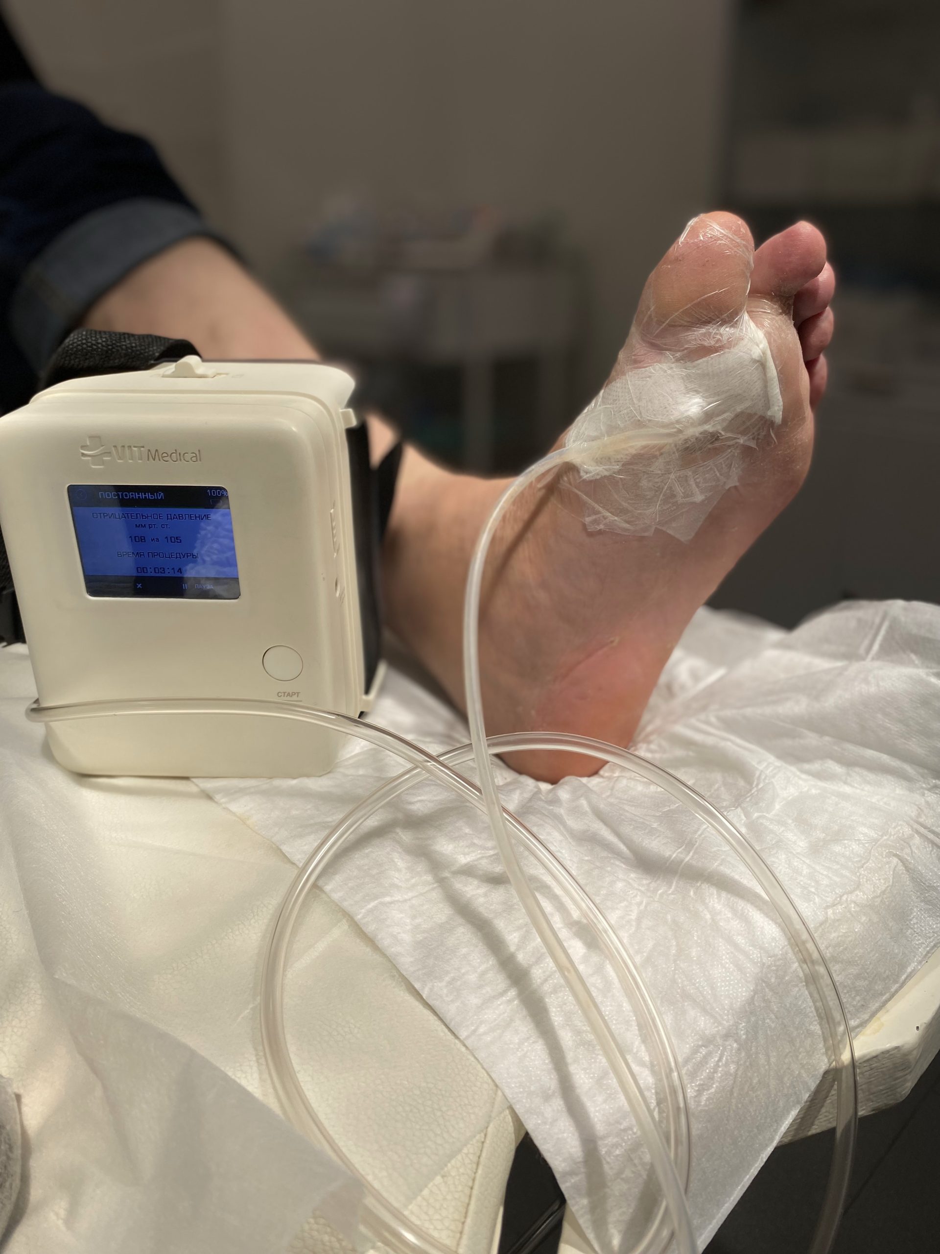 Показания к проведению вакуум-терапии ран