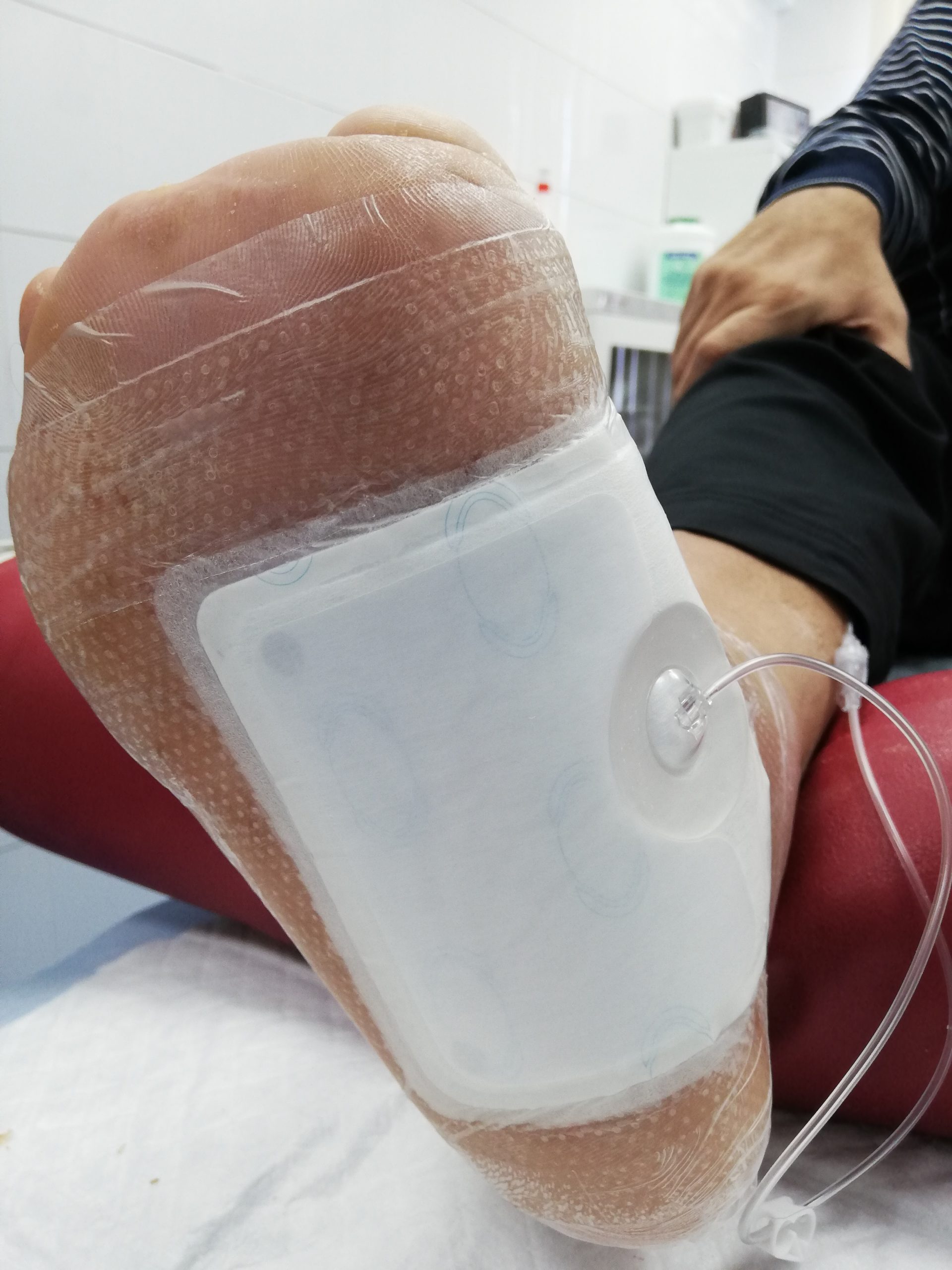 Вакуум-терапия ран