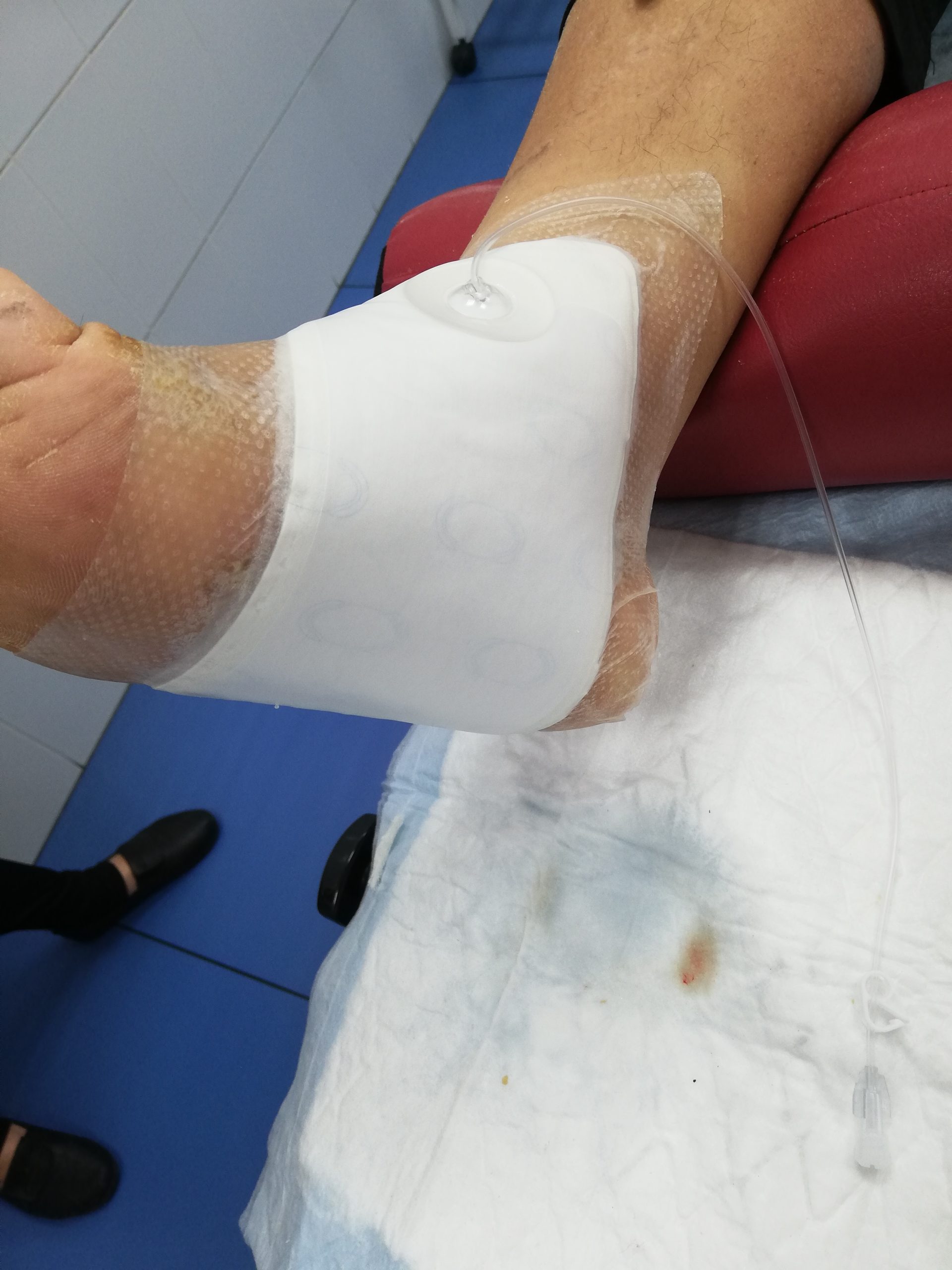 Подготовка к лечению ран вакуумом