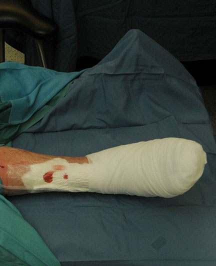 Лечение трофических язв лазером