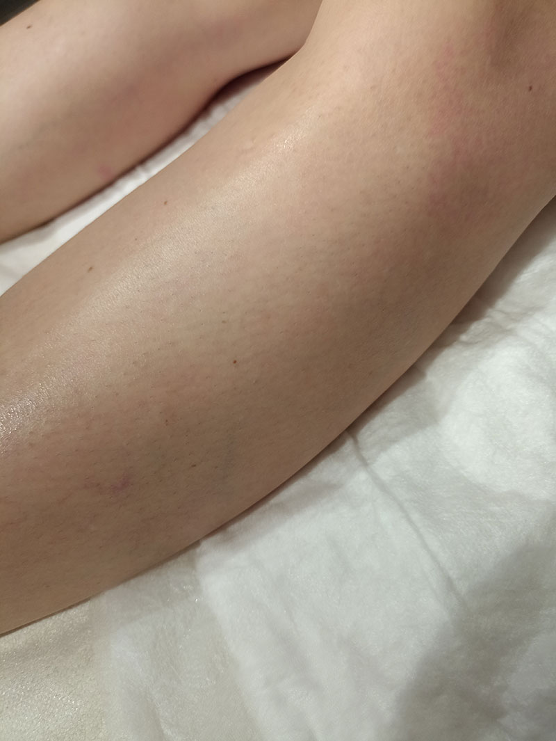 ЭХО-склеротерапия вен