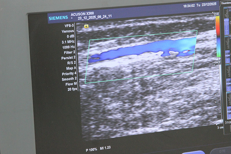 Преимущества склеротерапии под контролем УЗИ