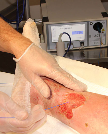 Лечение трофических язв лазером