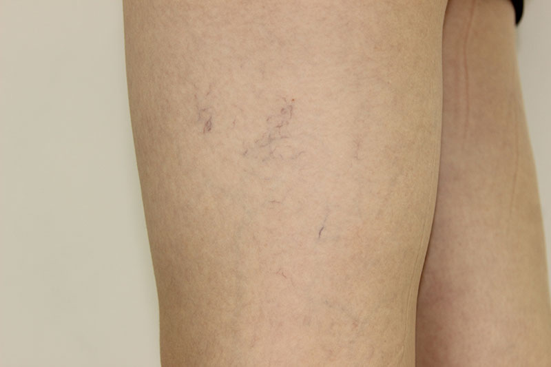 Показания к лазерному удалению сосудистой сетки на ногах