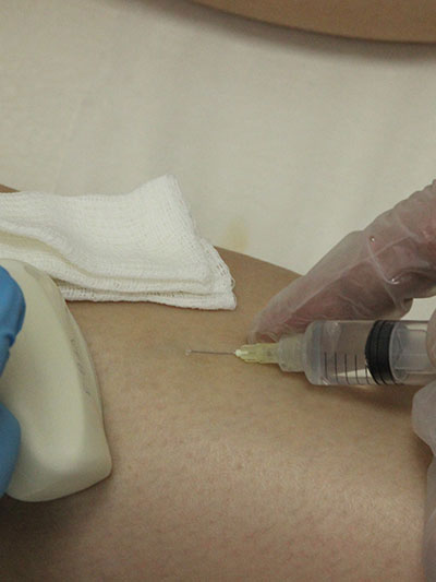 ЭХО-склеротерапия вен