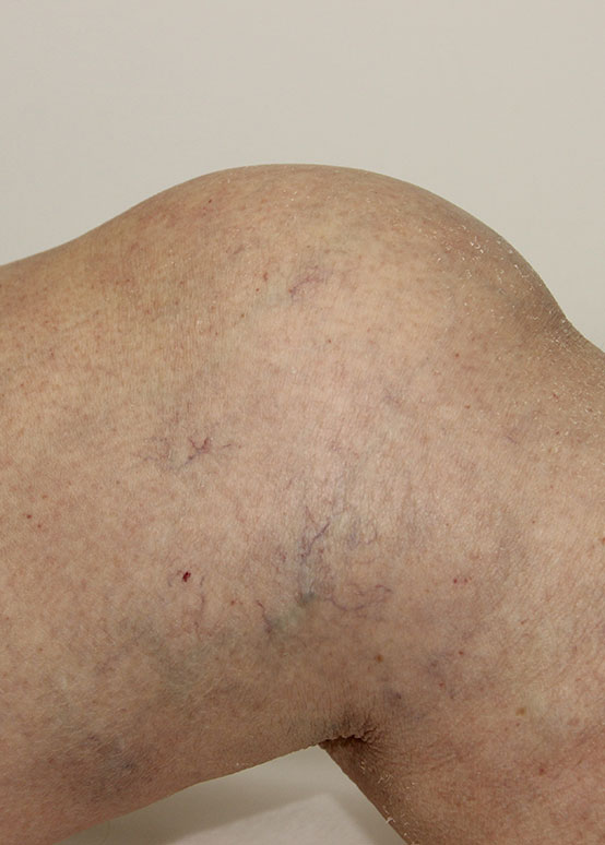 Уколы в колено для суставов