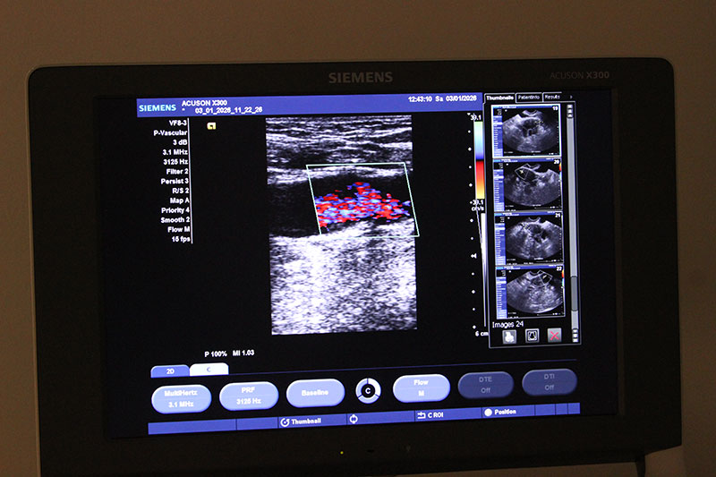 Что определяет УЗИ сердца