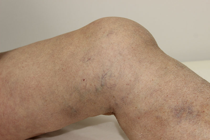 Преимущества инъекций гиалуроновой кислоты для суставов