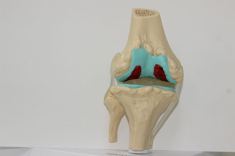 Какие препараты применяются для внутрисуставных уколов в колено