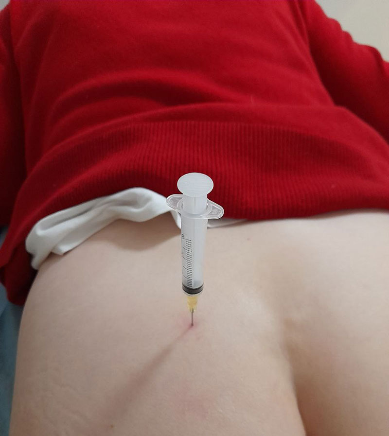 Симптомы тазовой боли