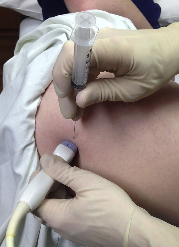 Лечение коксартроза тазобедренного сустава