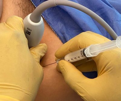 Причины артроза тазобедренного сустава