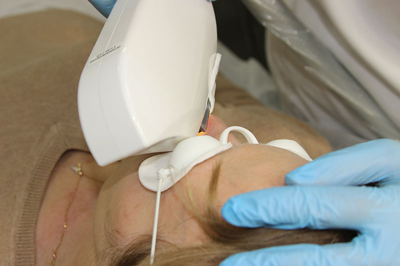 Показания к удалению капилляров на носу