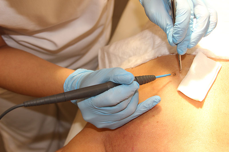 Преимущества радиоволнового метода удаления папиллом