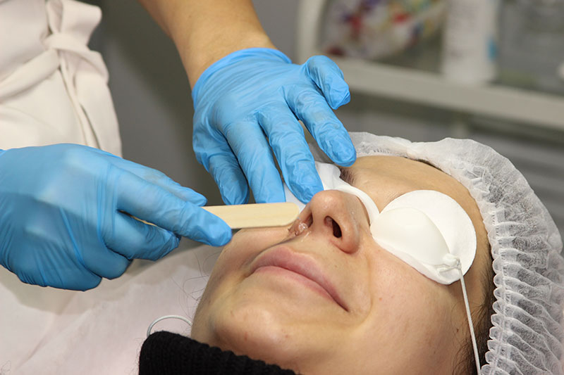 Преимущества удаления сосудистой сетки лазером