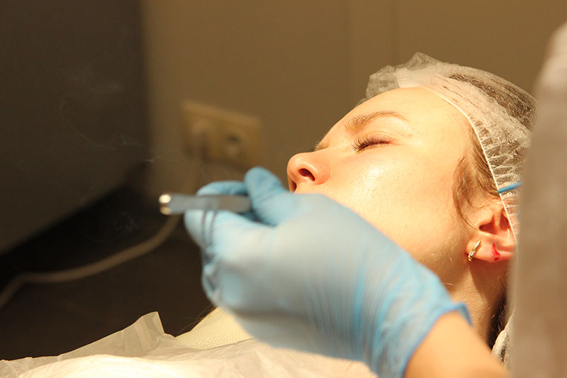 Преимущества лазерного удаления пигментации на лице