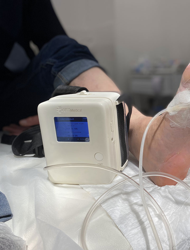 Аппарат ВИТ Мобил для вакуумной терапии