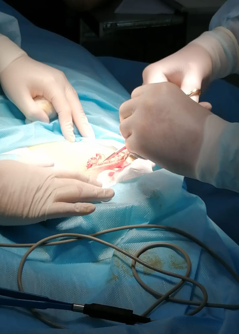 Удаление кисты яичника