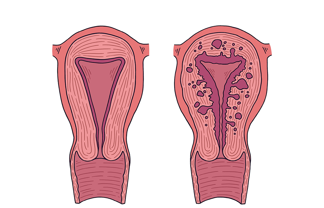 Классификация и стадии развития эндометриоза