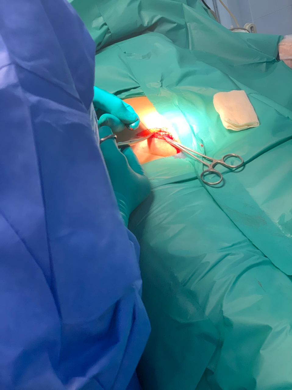 Причины эндометриоза