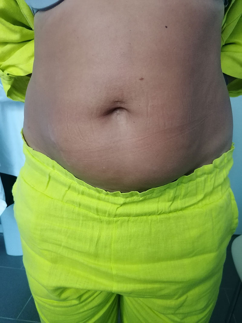 Как проходит удаление кисты яичника