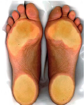 Преимущества сканера-плантографа PodoScan
