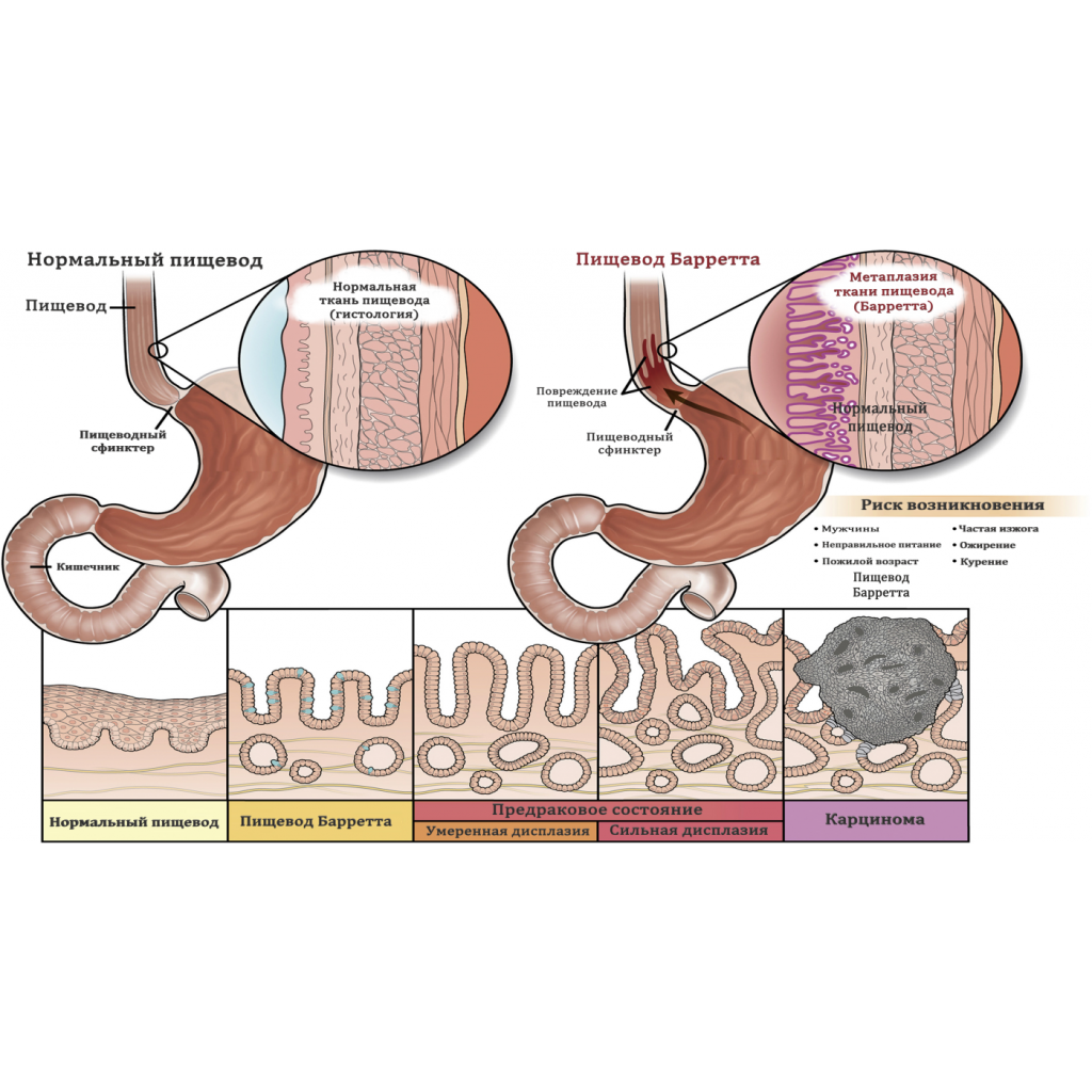 ПИЩЕВОД БАРРЕТТА